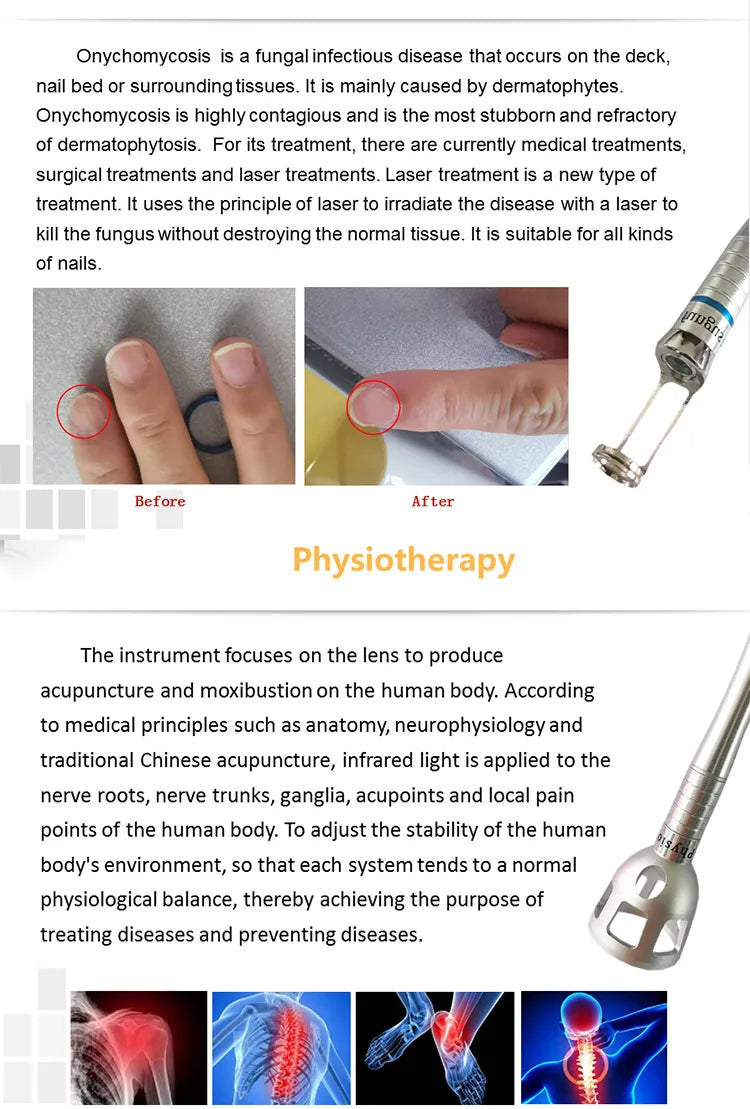 980Nm Laser Diode Vascular Spider Varicose Vein Removal Machine Treatment Fungi Physiotherapy