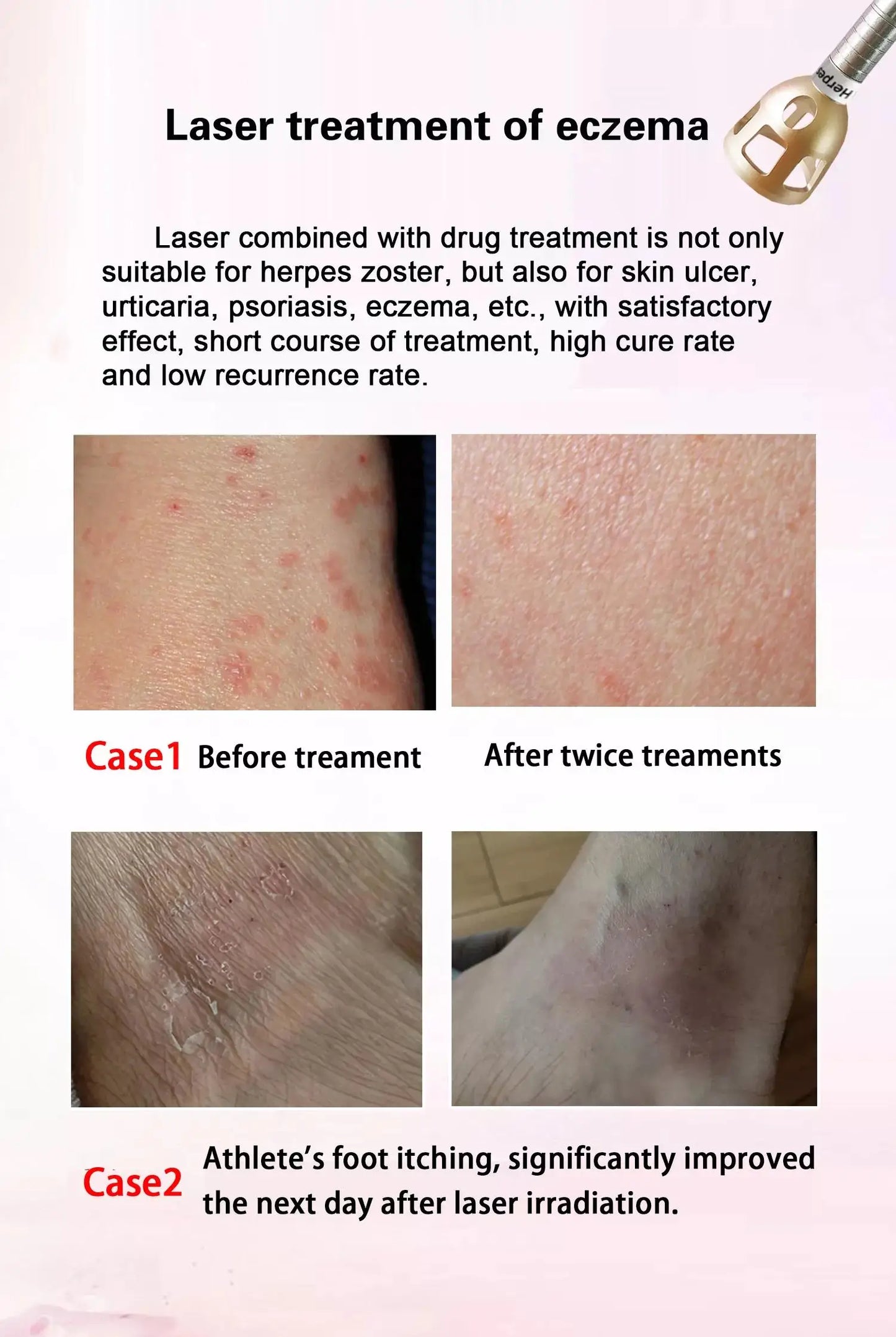 BEST 5 in 1 980nm Diode Laser Vascular Removal Machine Remove Spider Veins 980 Diode Laser Blood Vessels Removal Nail Fungus