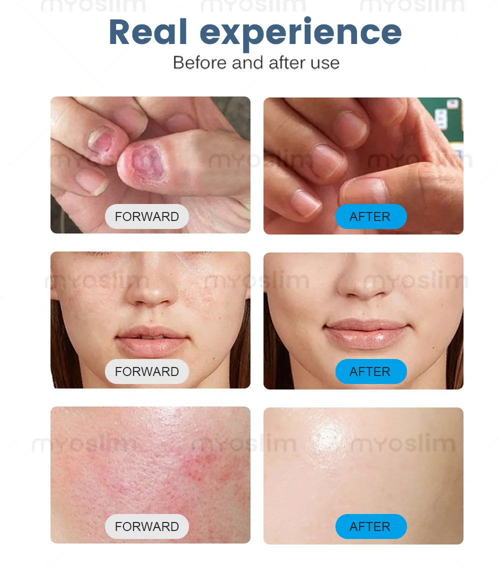 5-in-1 980nm Diode Laser To Remove Blood Vessels Nail Fungi To Remove Skin Eczema Restore Physical Body Therapy Beauty Functions